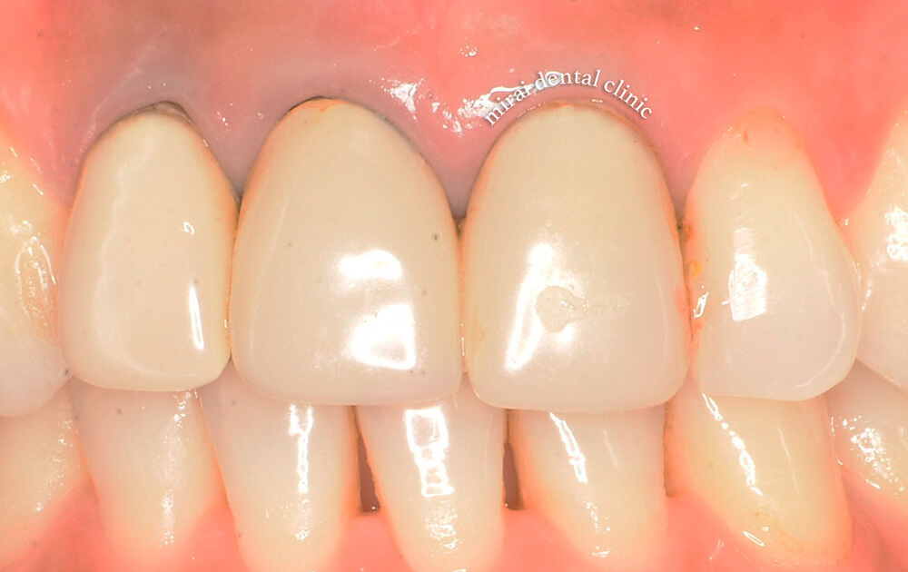 前歯の被せ物（治療前）