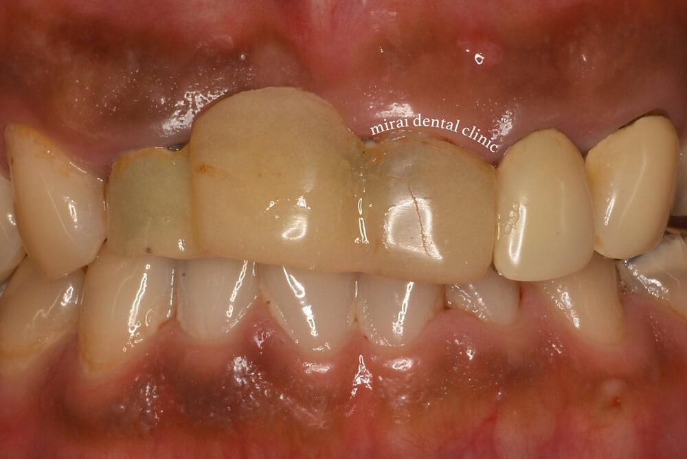 仮歯の症例1（治療前）