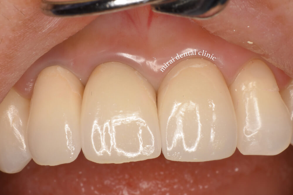 仮歯の症例1（治療後）