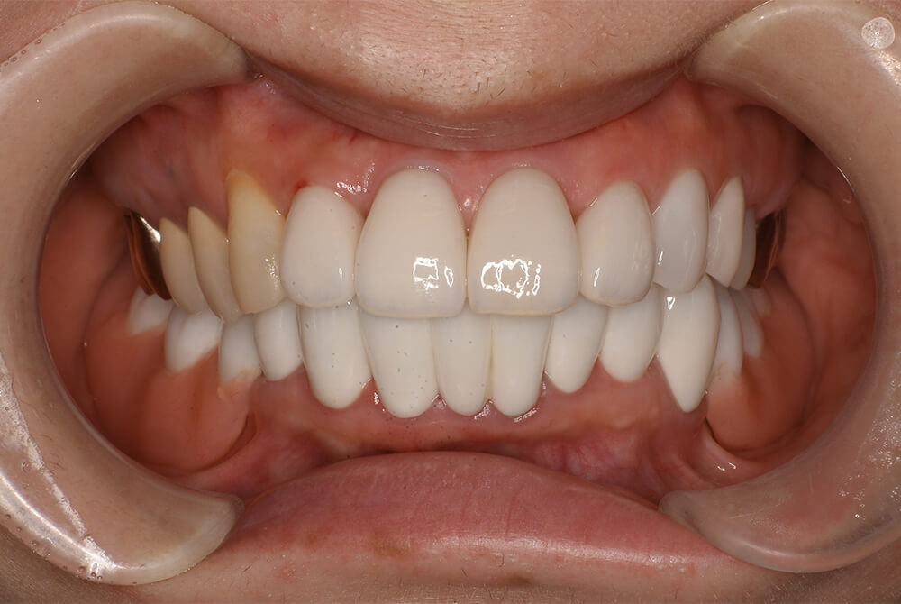 ドイツ式入れ歯の症例