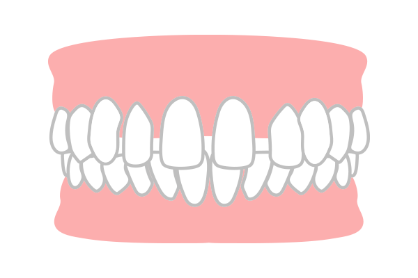 空隙歯列（すきっ歯）
