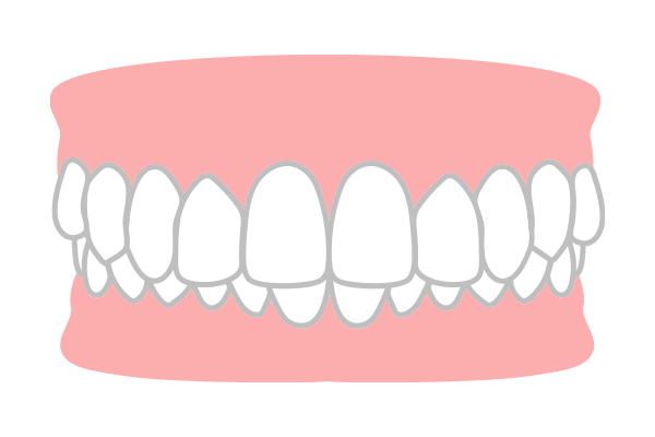 過蓋咬合（噛み合わせが深い）